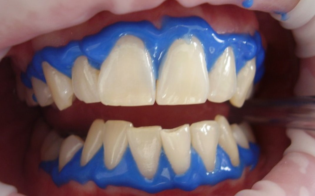 Skuteczne metody wybielania zębów - stomatolog Żoliborz